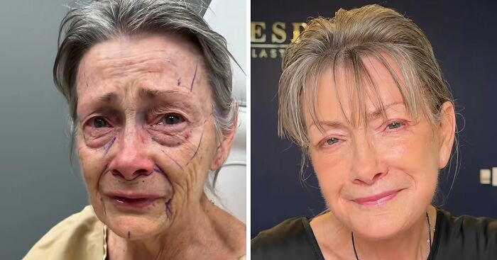 ‘Miracle’ Plastic Surgeon Goes Viral After Transforming Grandma To Look Decades Younger
