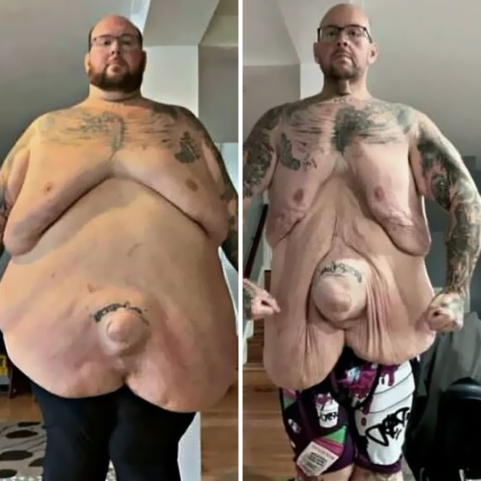 Man showing extreme skin sagging before and after significant weight loss, illustrating rare medical condition.