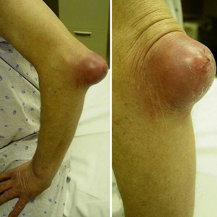 Severe medical swelling on elbow with skin irritation shown in detailed close-up images for medical caution.