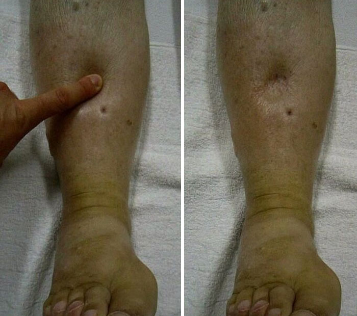 Close-up of swollen leg with discoloration, highlighting symptoms related to medical conditions like green hairy tongue.