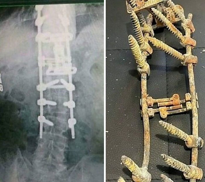 X-ray medical image showing spine with metal screws and rods used in surgical fixation, highlighting complex hardware placement.