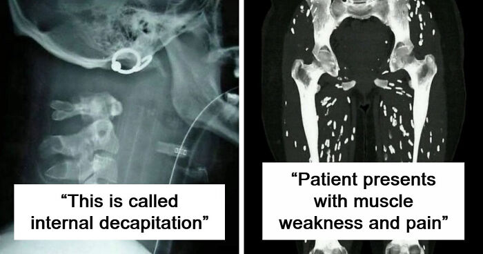 “Longest Neck In The World”: 41 Fascinating But Slightly Disturbing Medical Visuals (New Pics)