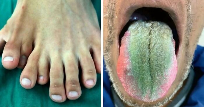 “Green Hairy Tongue!”: These 41 Medical Images That Should Be Viewed With Caution (New Pics)