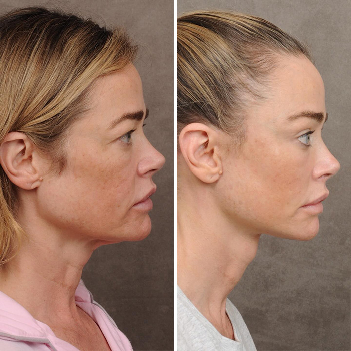 Denise Richards revela transformação dramática do facelift em fotos de antes e depois
