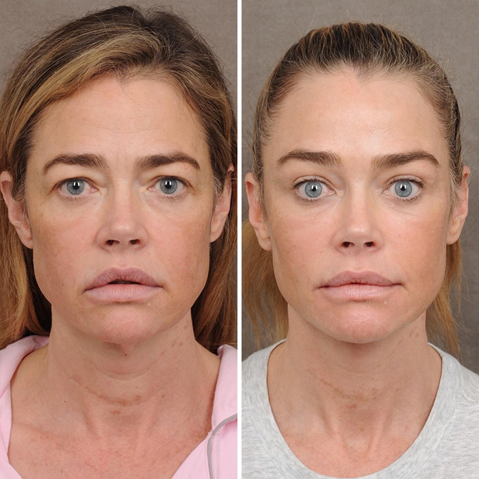 Denise Richards revela transformação dramática do facelift em fotos de antes e depois