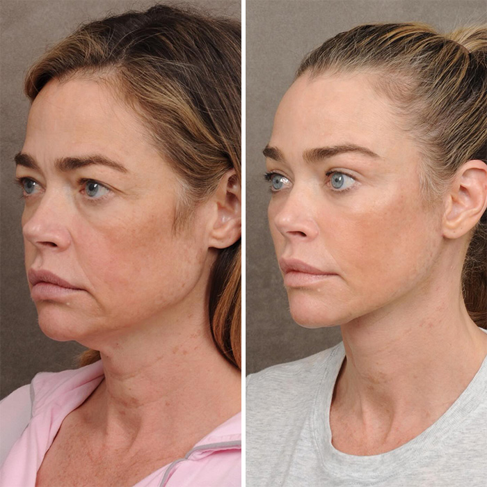 Denise Richards revela transformação dramática do facelift em fotos de antes e depois
