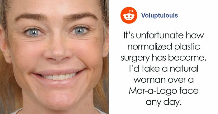 Denise Richards Reveal Before-And-After Look Following Wild Surgery