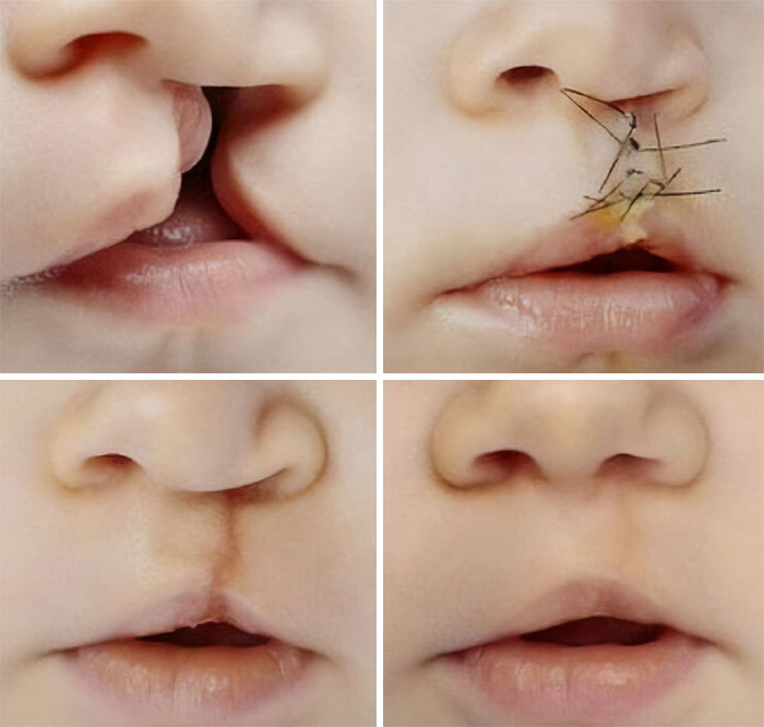 Close-up collage showing stages of a medical procedure repairing a cleft lip in an infant, unusual medical photos.