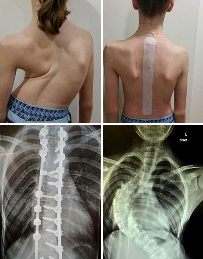 Medical photos showing severe spinal deformity, surgical correction, and X-rays illustrating unusual spine conditions.