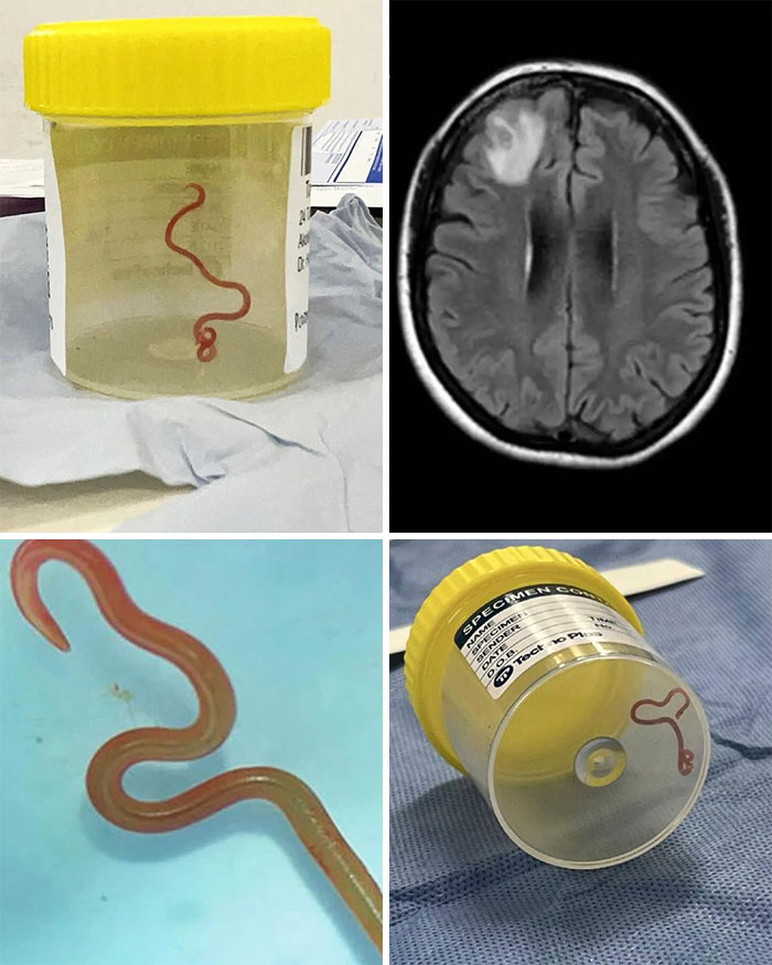 Collection of unusual medical photos showing a parasitic worm specimen and a brain scan with abnormal areas.