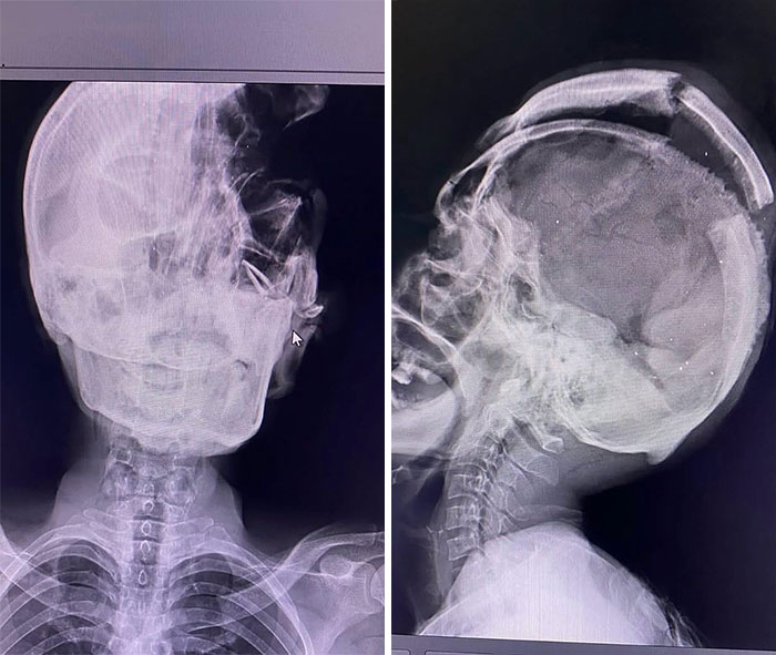 X-ray images showing unusual medical conditions affecting the skull and cervical spine in diagnostic medical photos.