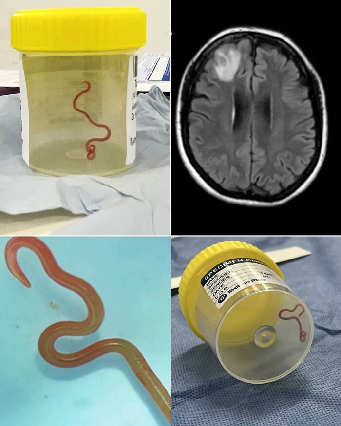 Collection of unusual medical photos showing a parasitic worm specimen and a brain scan with abnormal areas.