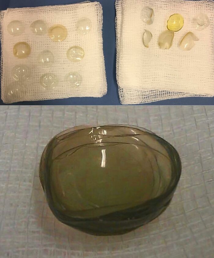 Various removed contact lenses displayed on medical gauze, showing unusual medical photos blending science and nightmare elements.