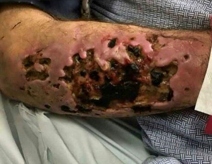 Severe arm skin injury with unusual wounds and tissue damage, showcasing disturbing medical conditions in unusual medical photos.