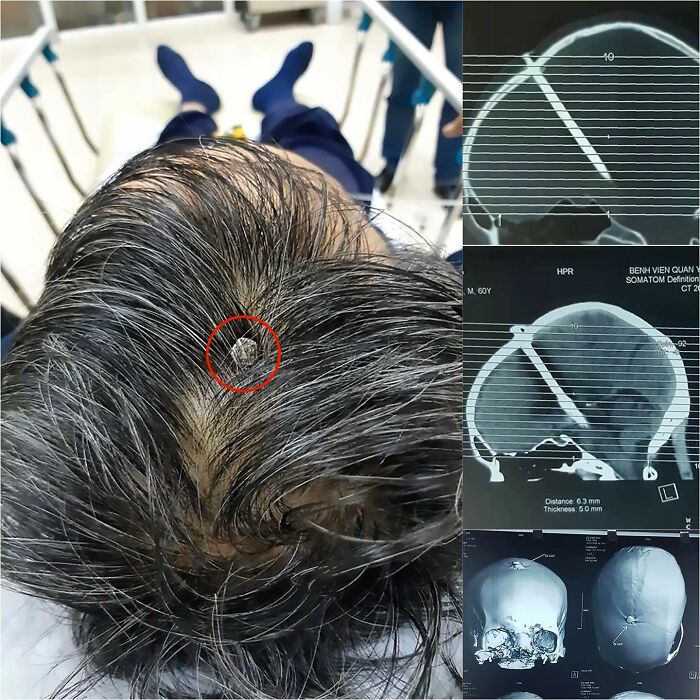 Close-up of a person's head with an unusual medical implant and corresponding medical scan images showing the object inside the skull.