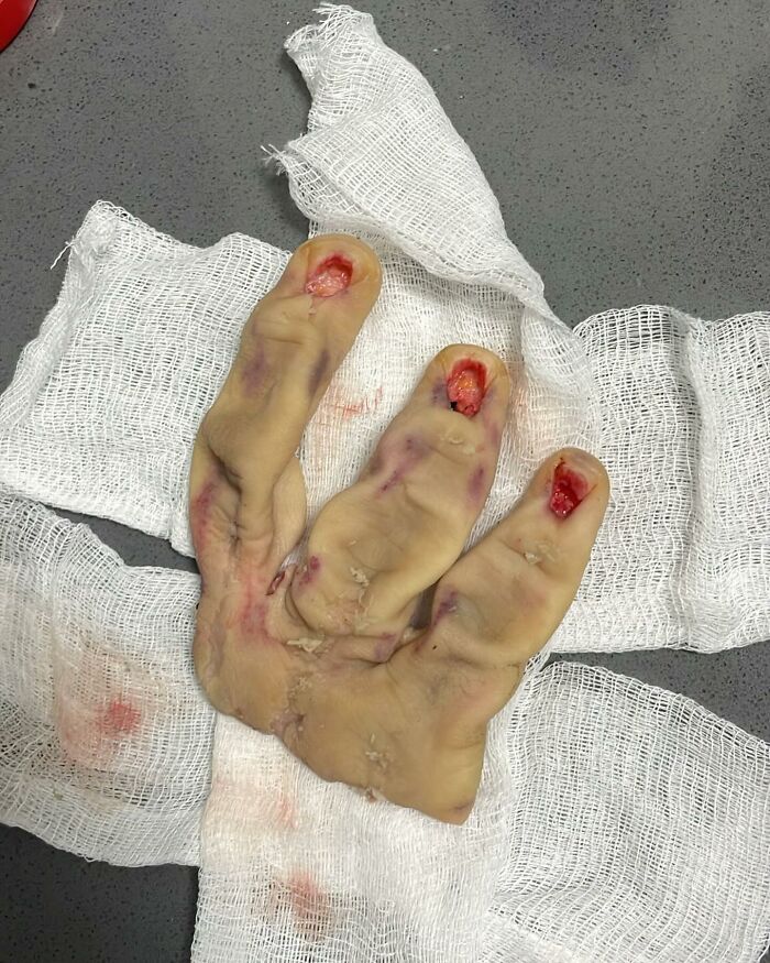 Severed medical specimen of toes with damaged nails and bruising, placed on white gauze in a medical setting.