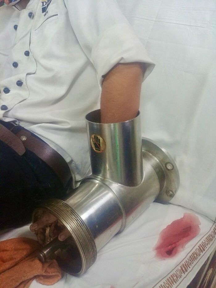 Man's arm trapped inside a metal pipe device, an unusual medical photo blending science and nightmare elements.