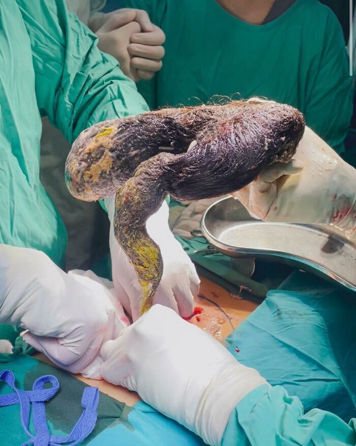 Surgeons in green scrubs removing a large, unusual medical mass during a complex surgical procedure.