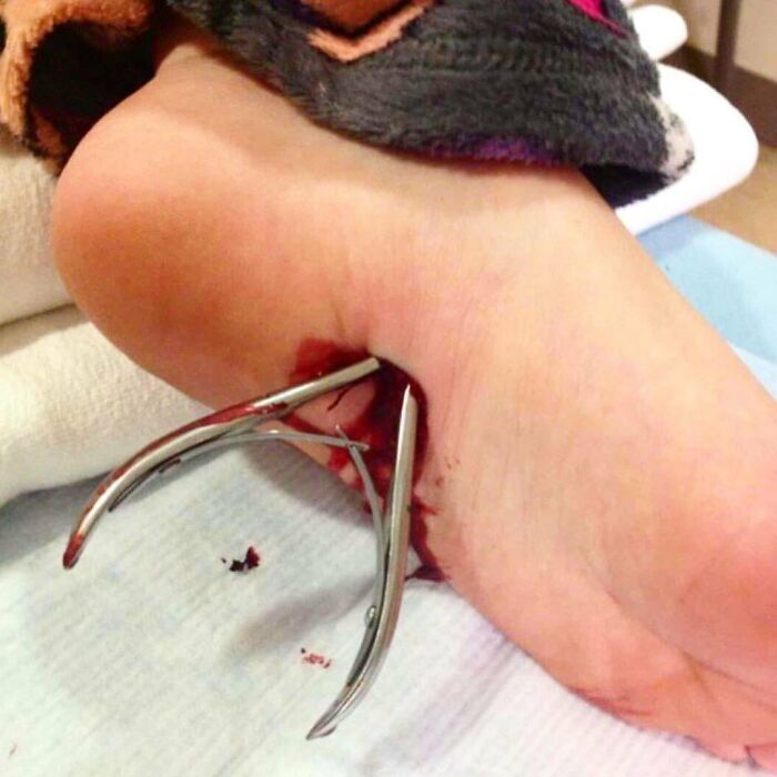 Medical photo showing a foot impaled by surgical scissors, highlighting unusual medical cases between science and nightmare.