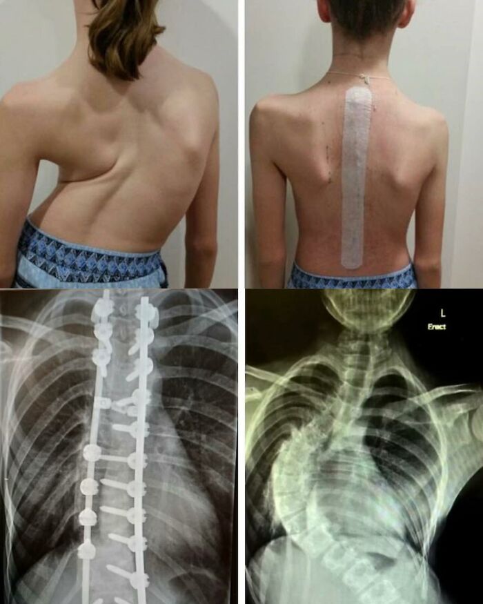 Medical photos showing severe spinal deformity, surgical correction, and X-rays illustrating unusual spine conditions.