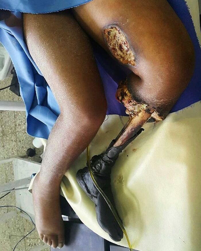 Severe leg infection and tissue damage shown in an unusual medical photo illustrating extreme science and nightmare cases.