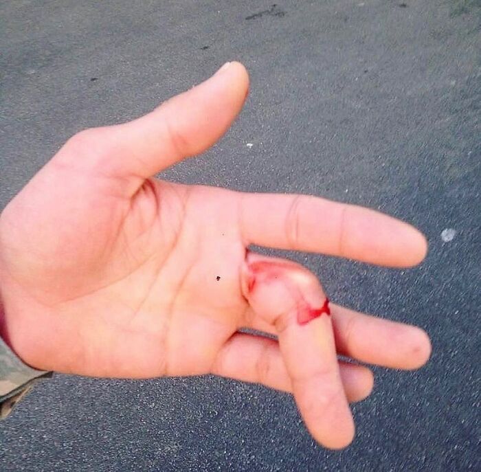 Close-up of a bloody injured finger showing unusual medical condition blending science and nightmare visuals.