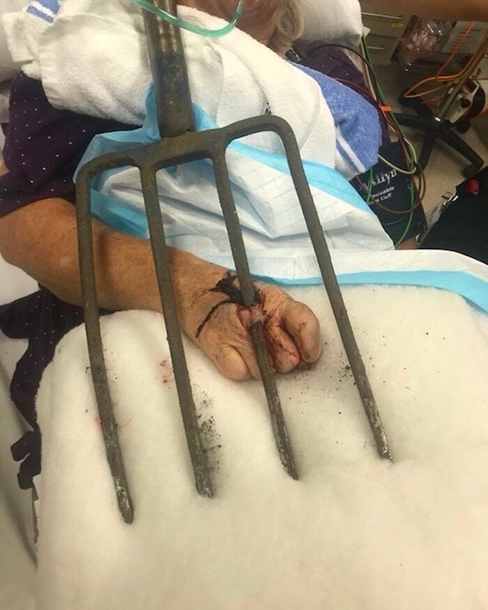 Patient with a pitchfork impaled through hand receiving emergency medical treatment in unusual medical photo.