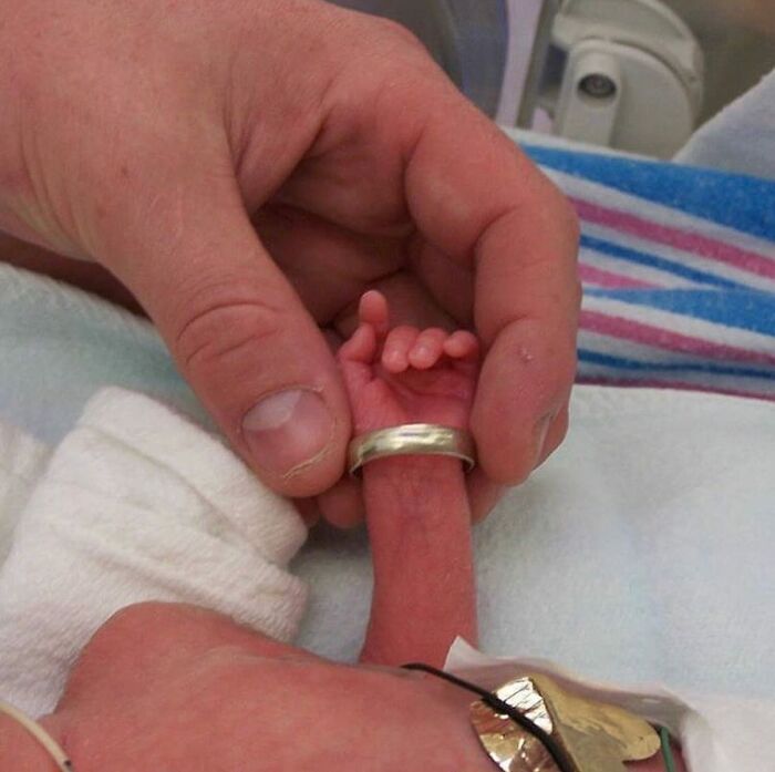 Premature newborn hand being gently held, highlighting unusual medical conditions and delicate neonatal care.