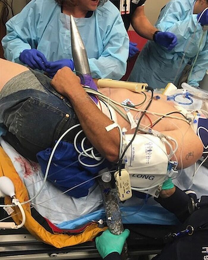 Patient with a large metallic object impaled through the body, surrounded by medical staff in an emergency setting.