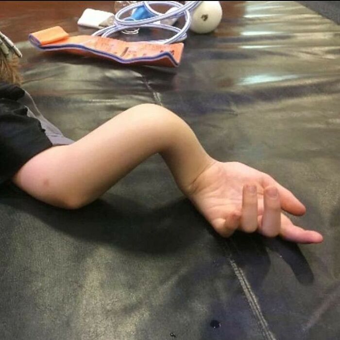 Child's arm bent at an unusual angle resting on a black surface, illustrating unusual medical photos between science and nightmare.