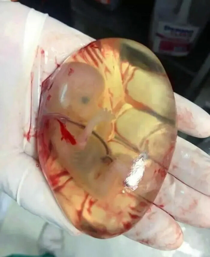 Gloved hand holding a transparent amniotic sac with a visible human embryo inside in an unusual medical photo.