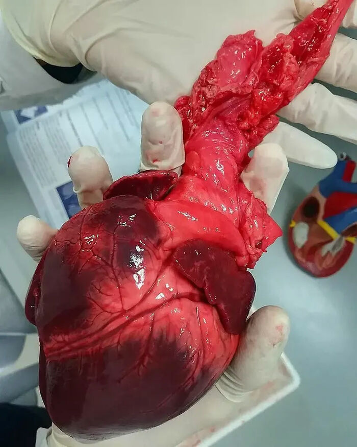 Gloved hands holding an unusual medical photo of a large, raw, exposed human heart with arteries and veins visible.