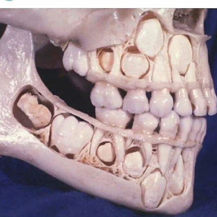 Cross-section of a human jaw showing unusual medical details of developing teeth between bone layers in a scientific photo.