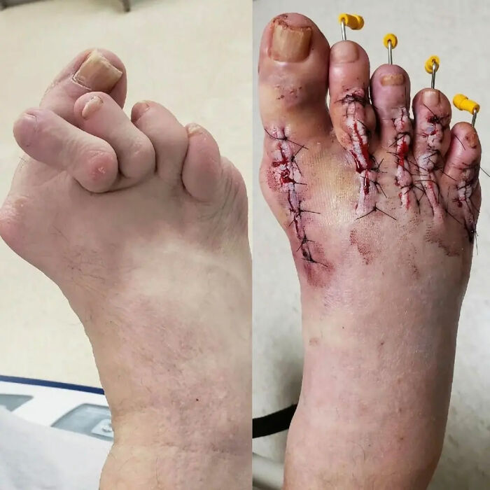 Before and after images of a foot surgery with pins and stitches showcasing unusual medical photos and procedures.