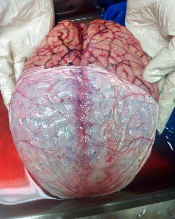 Close-up of an unusual medical photo showing a detailed human brain with visible membranes and blood vessels.