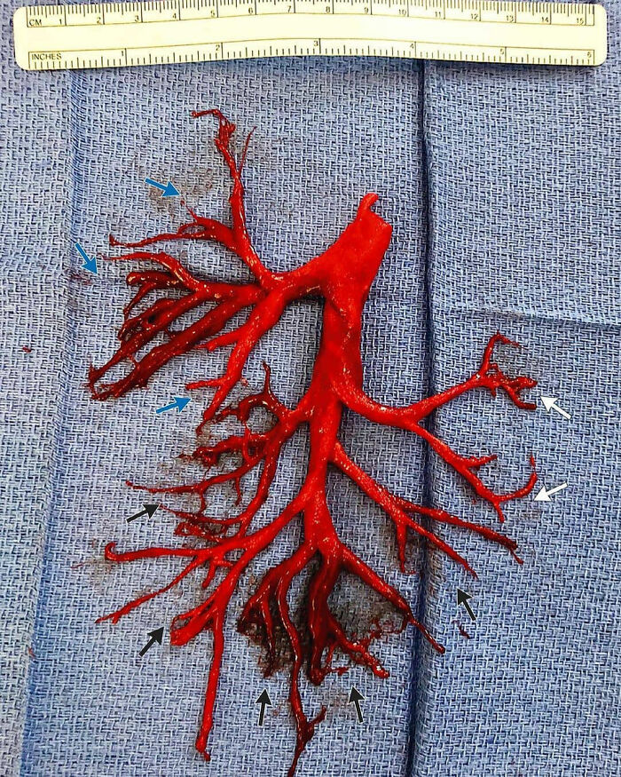 Red bronchial tree cast extracted from lungs, shown on blue surgical cloth with measuring ruler, unusual medical photos.