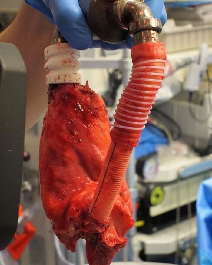 Medical photo showing an unusual lung attached to a breathing tube during a surgical procedure in a clinical setting.