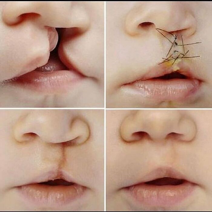 Close-up collage showing stages of a medical procedure repairing a cleft lip in an infant, unusual medical photos.