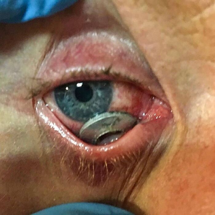Close-up of an unusual medical photo showing a metal object lodged inside a human eye, highlighting medical oddities.