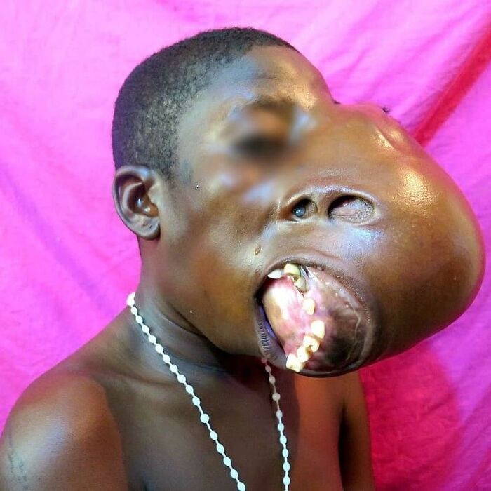 Man with a large facial tumor and distorted mouth posing against a pink background in unusual medical photos.