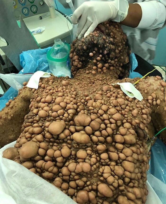 Patient covered with large unusual medical skin growths undergoing examination in a clinical setting illustrating unusual medical photos.