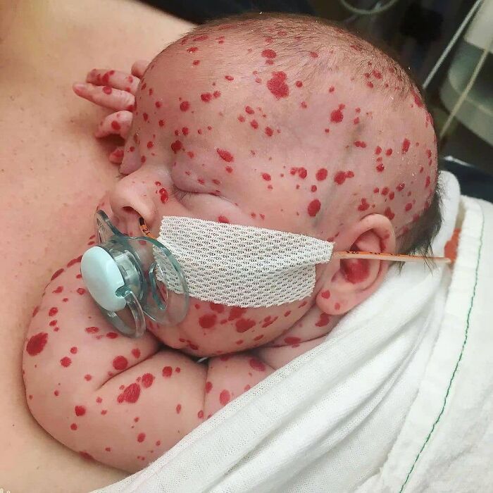 Infant with red spots all over the body resting while using a pacifier and medical tape, unusual medical photos with disturbing skin condition.