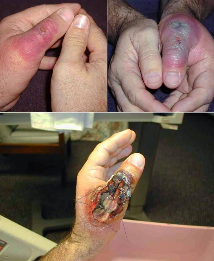 Severe finger infections and unusual medical conditions showing swollen, bruised, and necrotic tissue on thumbs.