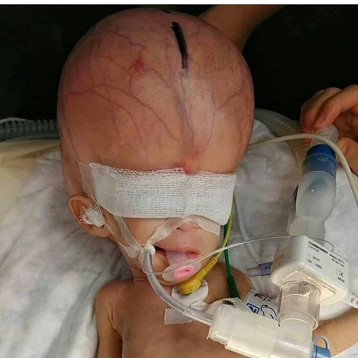 Infant with enlarged head connected to medical tubes and respirator, an unusual medical photo balancing science and nightmare imagery.