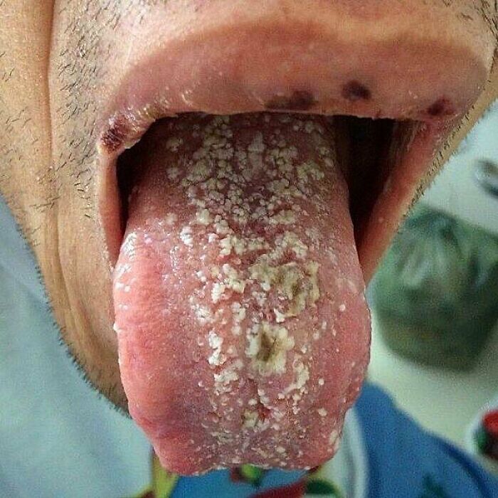 Close-up of a tongue with unusual medical condition showing clustered white lesions in a disturbing medical photo.