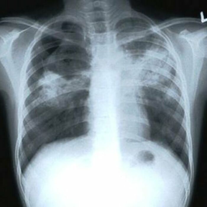 Unusual medical photo showing a detailed chest X-ray highlighting lungs, ribs, and spine anatomy in black and white.