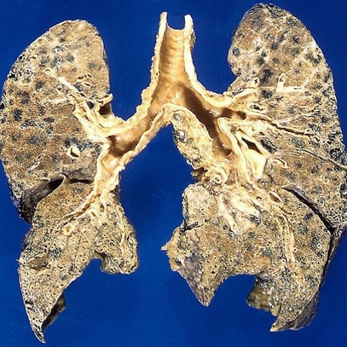 Discolored human lungs with tissue damage illustrating unusual medical photos between science and nightmare.