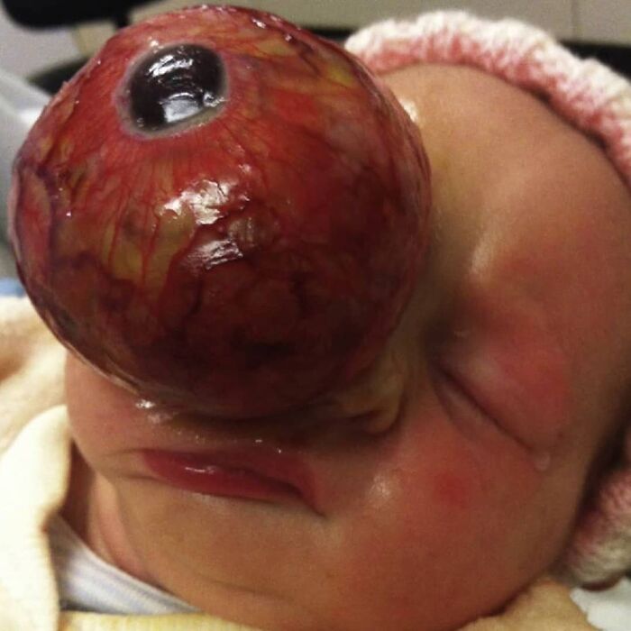 Newborn with a large, unusual eye growth covering one side of the face, a rare and disturbing medical condition.