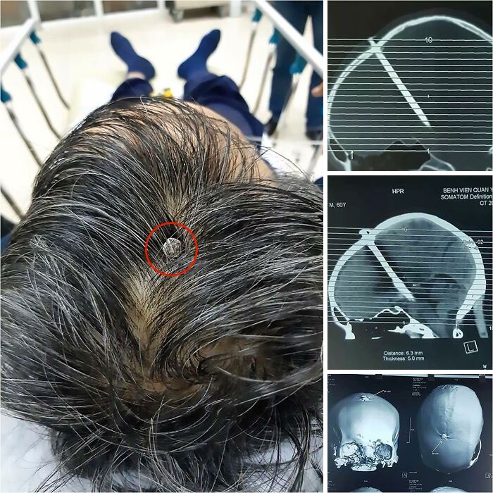 Close-up of a person's head with an unusual medical implant and corresponding medical scan images showing the object inside the skull.