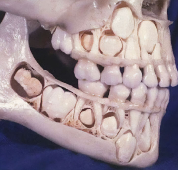 Cross-section of a human jaw showing unusual medical details of developing teeth between bone layers in a scientific photo.
